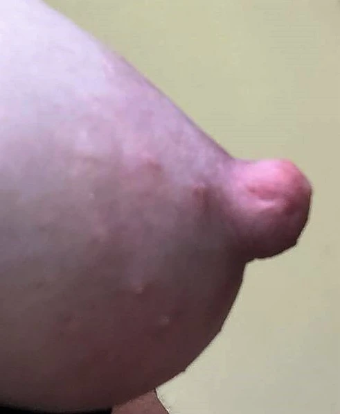 previouslypiercednipple